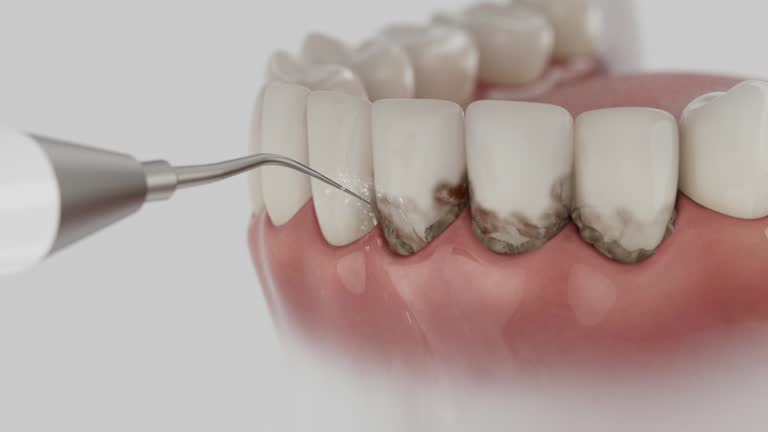 Trusted Wisdom Tooth Removal service in Splendora, TX - Dentist Open Now